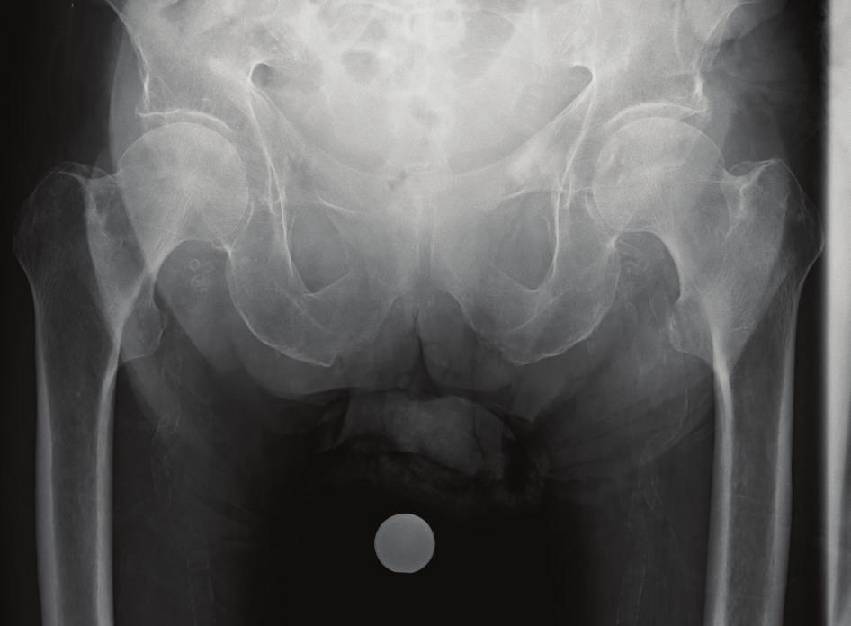 -B. Lee, E.-S. Moon, S.-T. Jung, and H.-Y. Seo, Subcutaneous emphysema mimicking gas gangrene following perforation of therectum:acasereport, Korean Medical Science, vol. 19, no. 5, pp. 756 758, 2004.