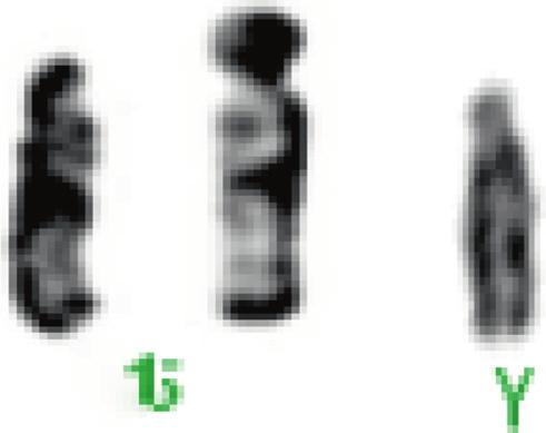 Neha Sudhir et al. Figure 2. Showing translocation 46,XY,t(6;11)(q14;p15). (a) Figure 3. Heteromorphic polymorphism in (a) chromosome 15ps + and (b) chromosome Yqh +.