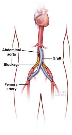 Patient information Bypass Surgery for Occlusive Disease Bypass surgery may be the only option for longer or more severe blockages in the abdominal aorta.