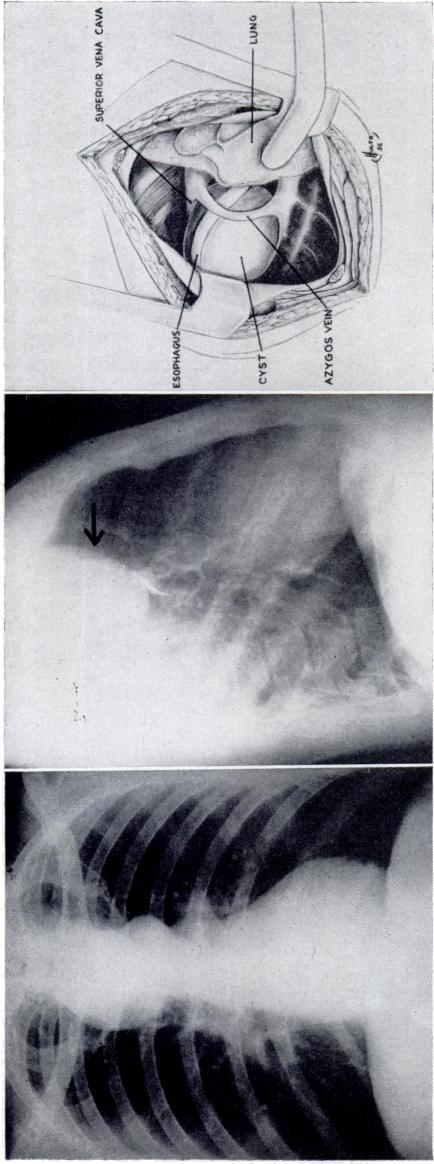 '\,,.' L U N FIGURE 27A FIGURE 27B FIGURE 27C Figure 27: Thoracic duct cyst. (A) PA view shows a location and appearance which could be confused with a bronchogenic cyst or neurogenic tumor.