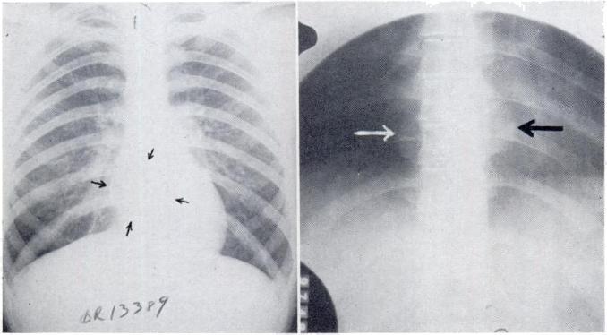 Three of those in the superior mediastinum presented in the neck. None of the 13 cysts had a patent communication with the tracheobronchial tree.