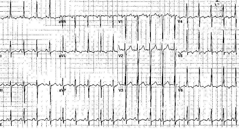 ECG -Hypertension Electrocardiogram from a 46-year-old man with long-standing
