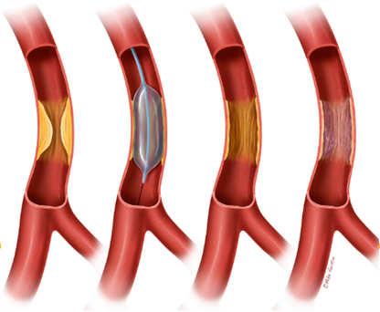 What Are the Available Treatment Options? 1. Balloon Angioplasty 2. Laser-cut Nitinol Stents 3.