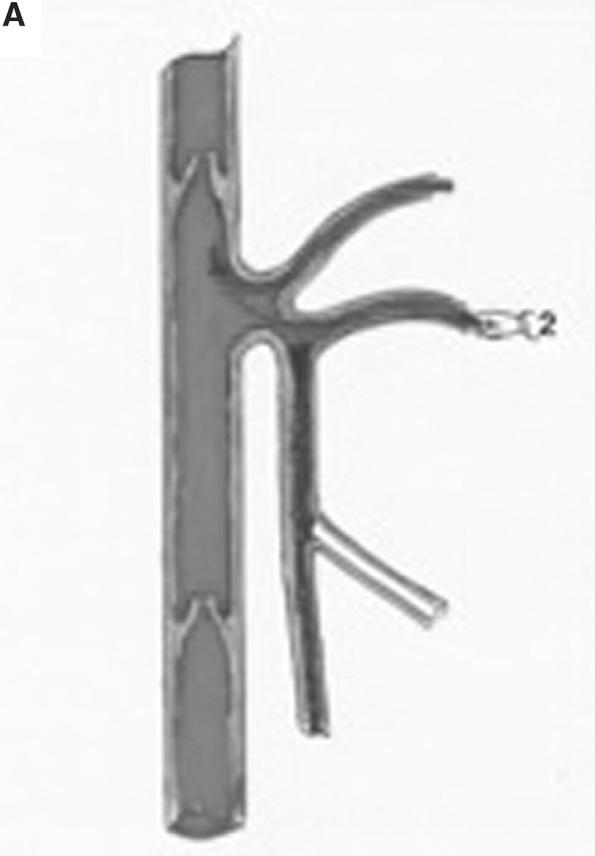 144 Vascular and Endovascular Surgery / Vol. 42, No. 2, April/May 2008 After the ELT, a foam sclerosis of incompetent side branches in combination with a limited Muller phlebectomy was performed.