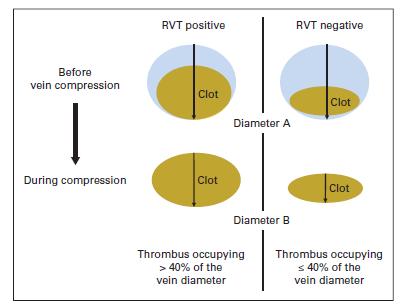 Evaluation of residual vein thrombosis