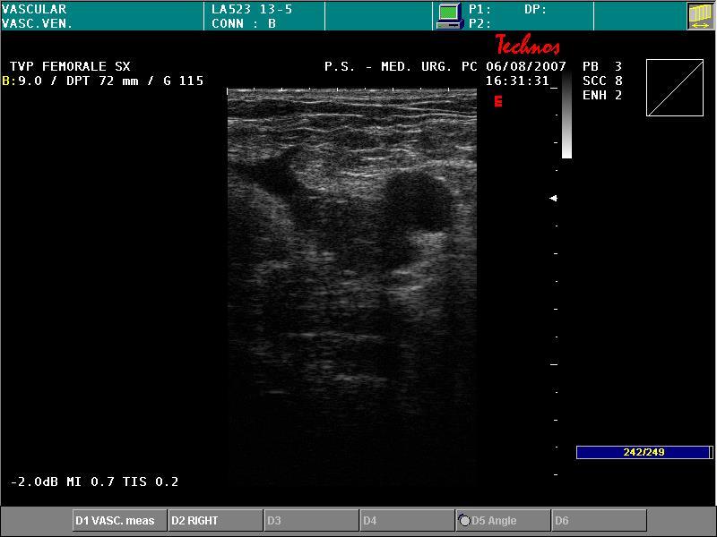 The r esid ual t hrom b us m ass Patients with previous DVT may have a residual thrombus within the vessel that appear partially uncompressible: DM 13 mm