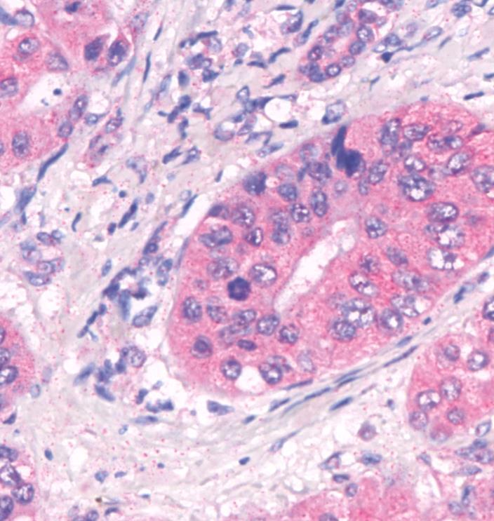REO 013: REOLYSIN Intravenus Mntherapy Metastatic Liver Lesin Image shws psitive (red staining) fr revirus in the metastatic lesins (blue arrw) and
