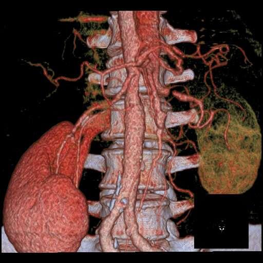CT Scan Kidneys