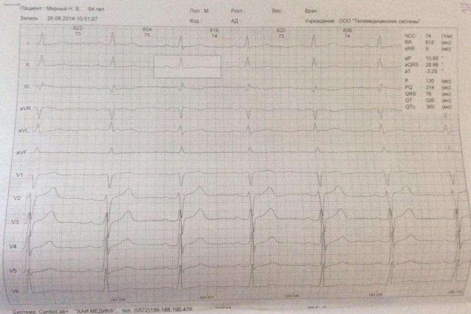 Electrocardiogram Sinus rhythm, heart rate 74, left axis