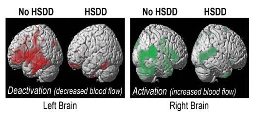 PET Scan Changes in Neural Activity in Response to Erotic Video Women with HSDD have weaker