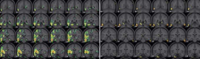 sexual cues Women with HSDD have less deactivation in left hemisphere possibly representing