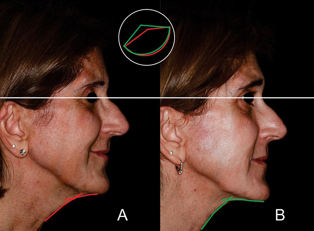 The improvement in the angle was 298 with better delineation of the jawline and good lifting and tightening as illustrated in the inset.