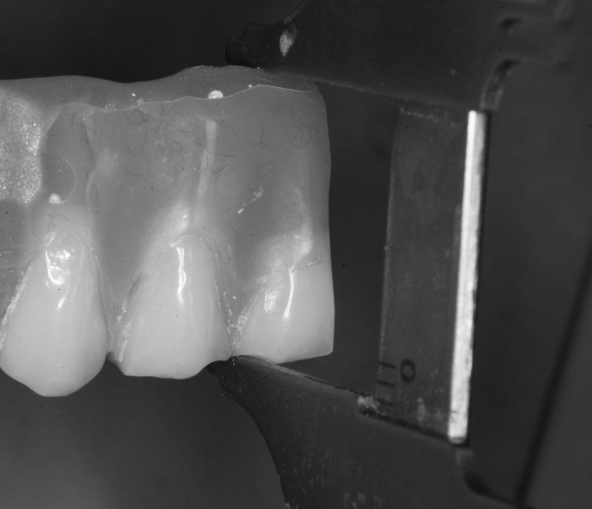 In an extensive literature review, Aglietta et al assessed survival rates of short-span, implant-supported cantilever fixed dental prostheses (ICFDPs) and the incidence of technical and biologic