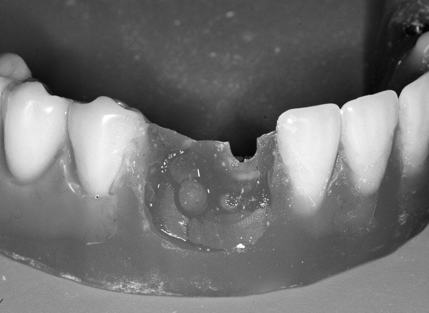 Drago Frequency of Prosthetic Complications in Immediate Full-Arch Loading Table 3 Number of days interim prostheses were in function per jaw Mean SD Q1 Median Q3 Mandible 195.44 114.43 154.00 169.