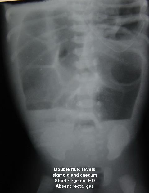 A double bubble without any gas below is diagnostic of duodenal atresia; the gastric bubble here may be very large (Fig.1).