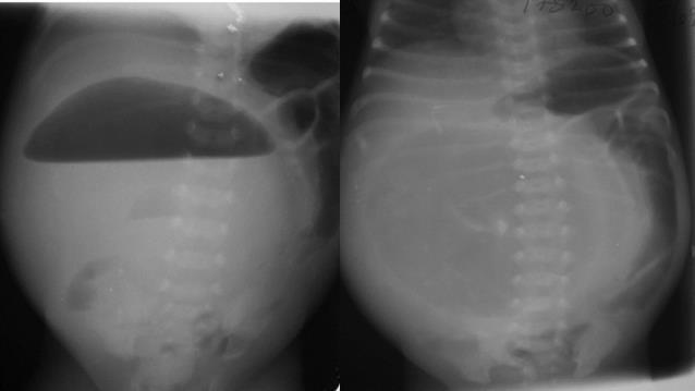 Air contrast studies: Could be done for better differentiation in some conditions; Upper GI air contrast studies are valuable in the diagnosis of duodenal obstruction.