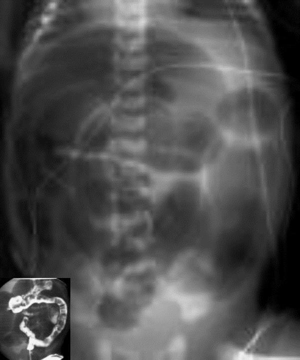 like coins, intra venous catheters, pens mobiles of staff. Figure 10: Gasless abdomen. Collateral signs include: Calcification; Abnormal pockets of gas; Abnormal vertebrae; Skeletal anomalies.