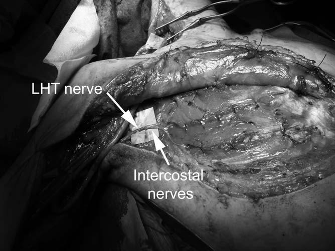 8 Goubier et al. Figure 1. A continuous thoraco-brachial incision to harvest intercostal nerves and expose the long head of the triceps nerve (LHT nerve). Nerves are sutured in the axilla.