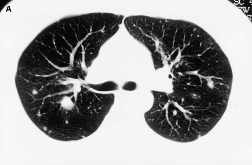 438 E. Schwartz / Clin Chest Med 23 (2002) 433 443 Fig. 3. (A) CT scan through the bifurcation of the trachea that shows multiple lesions of different sizes in both lungs.