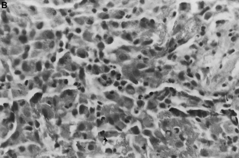 hyperplasia of type II pneumocytes lining the alveolar septae (arrowheads). A focus of intraalveolar organization is seen in the right upper field. (Hematoxylin and eosin, 200).