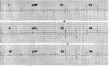 106 Hong Kong j. emerg. med. Vol. 9(2) Apr 2002 Figure 1. Initial ECG. Figure 2. Ventricular fibrillation as documented on cardiac monitor. catheterisation showed normal study.
