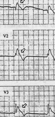 108 Hong Kong j. emerg. med. Vol. 9(2) Apr 2002 Coved ST-segment elevation. Saddleback ST-segment elevations. Figure 3. ECG features that are suggestive of Brugada syndrome. Table 1.