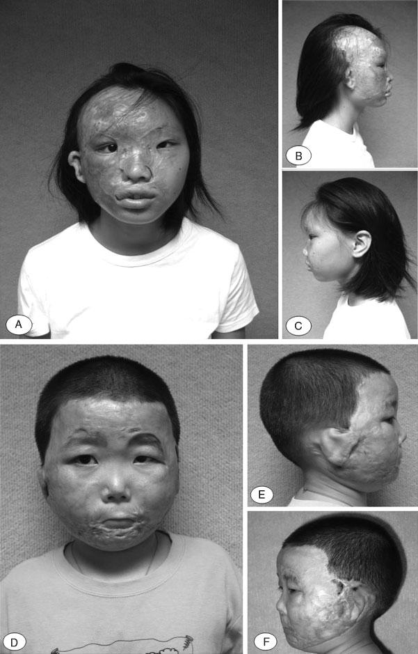 BURNS: TREATMENT AND OUTCOMES/BURD 271 Figure 6 (A) This girl has had severe burns to the right side of the face, and (B) the right ear has been pulled forward by the scarring on the right cheek.