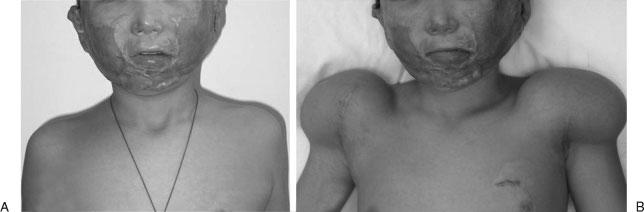 274 SEMINARS IN PLASTIC SURGERY/VOLUME 24, NUMBER 3 2010 Figure 9 This boy is the same patient who appeared in Fig. 6D F.
