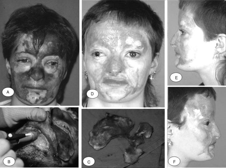 266 SEMINARS IN PLASTIC SURGERY/VOLUME 24, NUMBER 3 2010 Figure 2 (A) This patient was assaulted with nitric acid and sustained full-thickness burns of the forehead, nose, and cheeks.