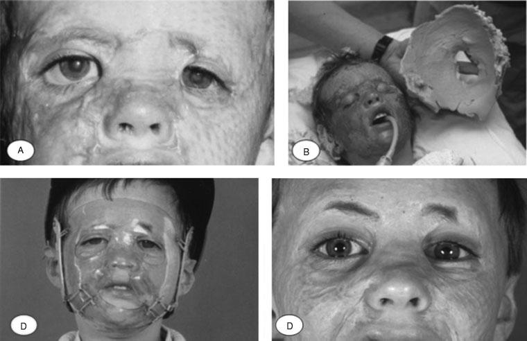 BURNS: TREATMENT AND OUTCOMES/BURD 267 Figure 3 This boy was involved in an explosion in a closed space and sustained deep burns of the hands and face.