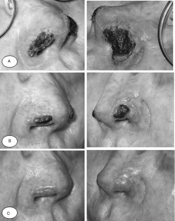 BURNS: TREATMENT AND OUTCOMES/BURD 269 Figure 4 This series of pictures shows the healing of composite grafts applied to both right and left ala margins at 2 week intervals.