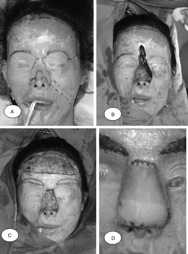 270 SEMINARS IN PLASTIC SURGERY/VOLUME 24, NUMBER 3 2010 Figure 5 This patient was the victim of an acid assault that left her blind.