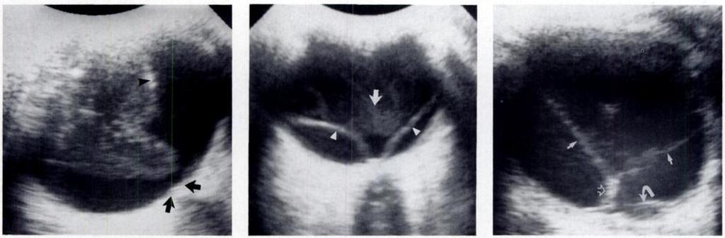 AJR:163, October 1994 OCULAR SONOGRAPHY 923 is incomplete, the vitreous remains bound at some point to the retina. This may occasionally resemble retinal detachment.
