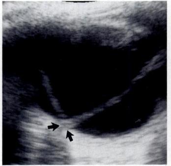 in this condition, the choroid balloons into the eye (Fig. i5). The choroid protrudes into Fig. 12.-Focal bullous retinal detachment (arrow) shown by axial sonogram.