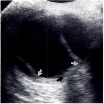 AJR:163, October 1994 OCULAR SONOGRAPHY 925 the vitreous in a biconvex manner that can be seen in all planes of imaging. During dynamic scanning, this appearance does not change.
