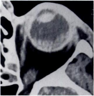 B, Contrast-enhanced axial CT scan (2-mm slice thickness) shows difficulty in differentiating margin of melanoma from associated retinal detachment.
