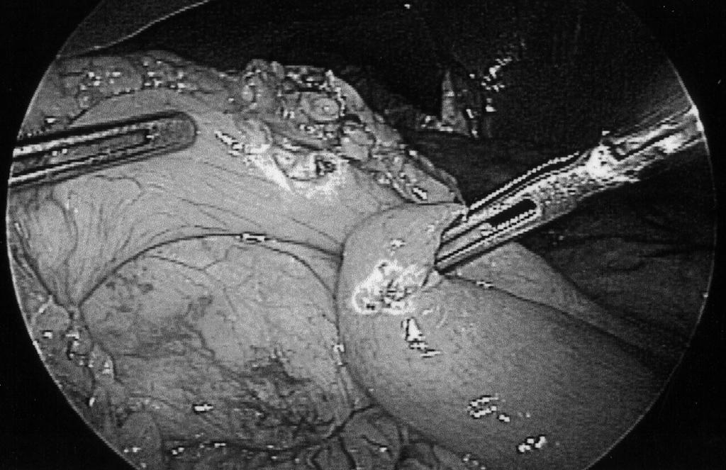The gallbladder is removed to facilitate construction of the common hepatic duct anastomosis and to prevent the possible later complication of cystic duct obstruction and cholecystitis.