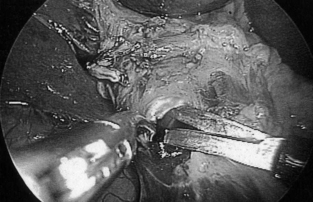 Insertion of the jaws of an Endo-GIA stapler into the hepatic duct and jejunum.