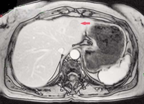in the peritoneal cavity (F) A B Figure 2.