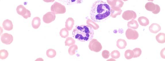 8 Platelet count (10 9 /L) 546 Slide 017 was prepared from the peripheral blood obtained from a 54 year-old male.