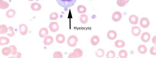 Few immature white blood cells were reported by participants, the participant range for both myelocyte (Image 2) and metamyelocyte was 0 2.