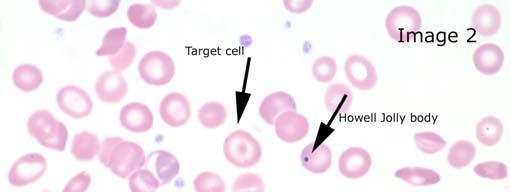 SLIDE 018 35 year-old male DIAGNOSIS: Sickle Cell Anemia WBC (10 9 /L) 16.8 RBC (10 12 /L) 2.53 Hemoglobin (g/dl) 7.3 Hematocrit (%) 21.9 MCV (fl) 86.6 MCH (pg) 28.9 MCHC (g/dl) 33.3 RDW (%) 18.