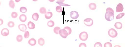 The clinically significant findings in this case as reported by participants and as would be expected in such a case included sickle cells, Howell-Jolly bodies, target cells, and nucleated red blood