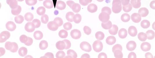 There were many large platelets present in this case and few giant platelets as
