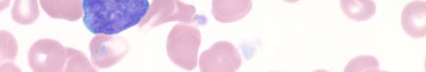 The automated differential results included 63% segmented neutrophils, 12% lymphocytes, 4% metamyelocytes, and 3% abnormal