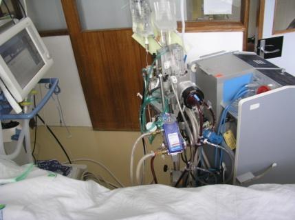 ECMO: extracorporeal membrane oxygenation External blood pump connected to a membrane oxygenator similar to the cardiopulmonary bypass system used in