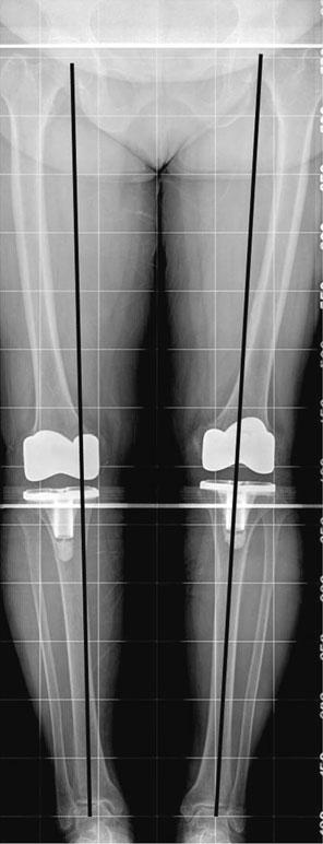 Knee Surg Sports Traumatol Arthrosc (2011) 19:1069 1076 1075 Fig. 2 A 67-year-old woman with bilateral TKA.