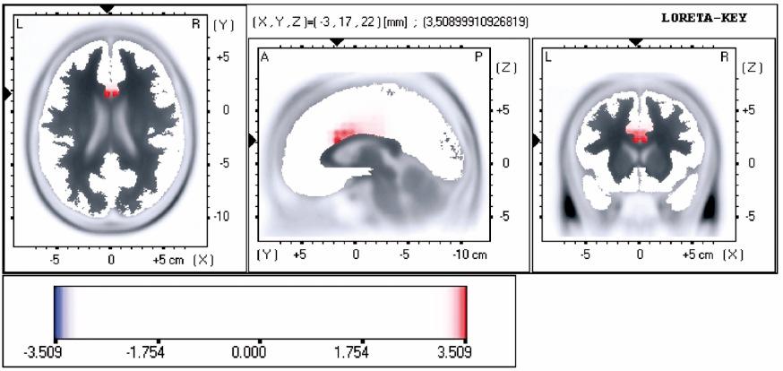Anterior cingulate cortex activity is associated with a gain in reaction speed, at the expense of spatial accuracy subjects with short reaction times showed significantly more ACC
