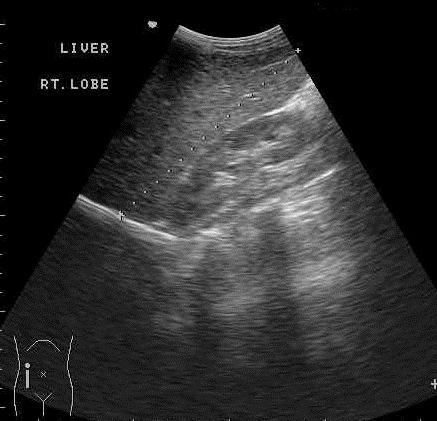 Legend of figures Figure1: ultrasound image show late stage liver cirrhosis.
