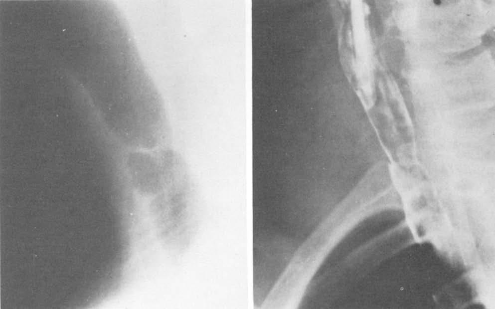 LEFEMINE, MAC DONNELL, AND MOON A FIG. I. (A) Oblique view of a thin, membranous obstruction of the trachea following use of a cufled endotracheal tube.